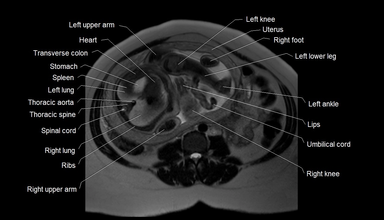 MRI fetal anatomy axial image 13.webp